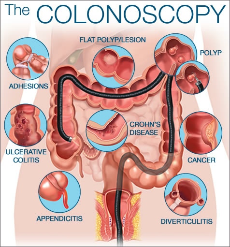 colonoscopy-for-bowel-problems-glasgow-colorectal-centre